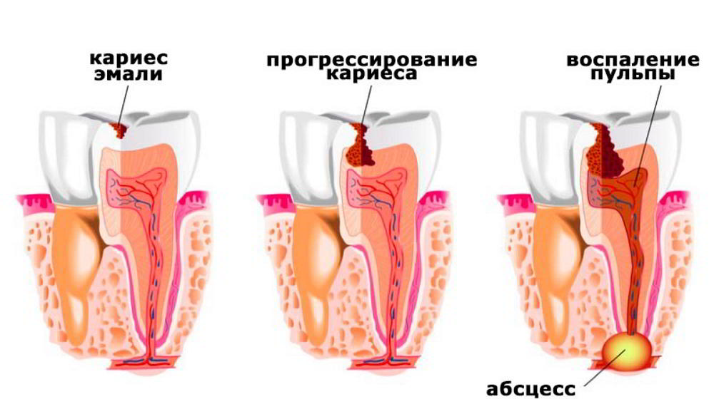 Формирование кариеса зуба от кариеса эмали до абсцесса