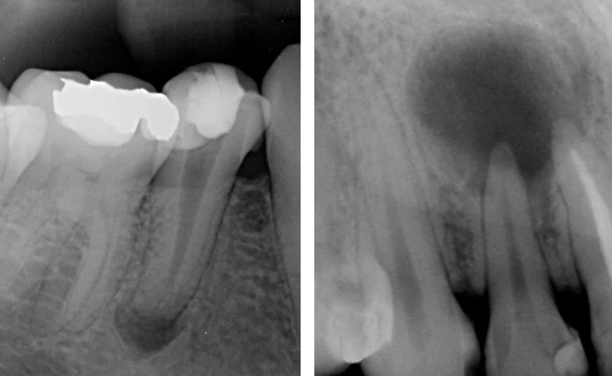 Фото ренген корневых каналов